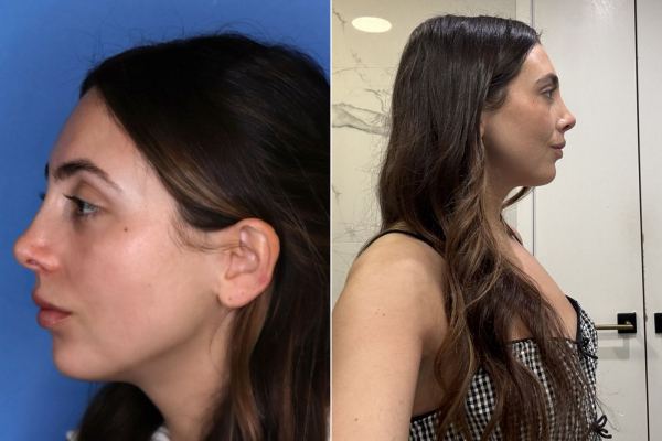 side view of a nose before and after a revision rhinoplasty